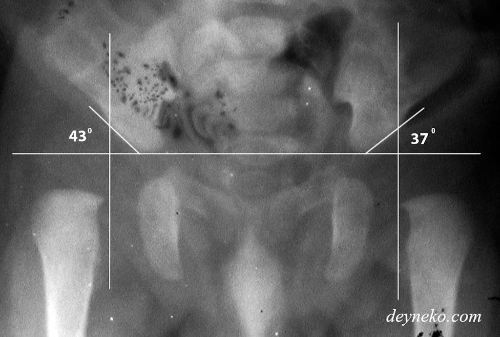 Нормы углов тазобедренных суставов. Дисплазия тазобедренных суставов ацетабулярный угол норма. Ацетабулярный угол у детей норма таблица. Дисплазия тазобедренных суставов ацетабулярный угол. Ацетабулярный угол рентген норма.